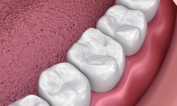 Animated tooth with mercury free composite resin filling