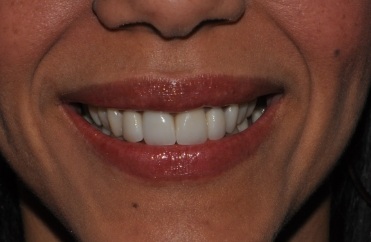Smile after closing large gap between front teeth