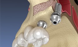 a digital illustration of a sinus lift