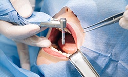 Dental implant surgery is where your dentist attaches the dental implant post to your jaw
