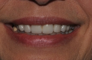 smile with closed gap between front teeth