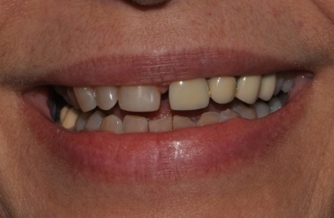 Smile with gap between front teeth