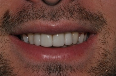 Smile with perfectly aligned teeth