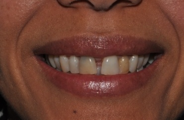 Smile with large gap between teeth