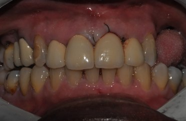 Smile after replacing top front tooth