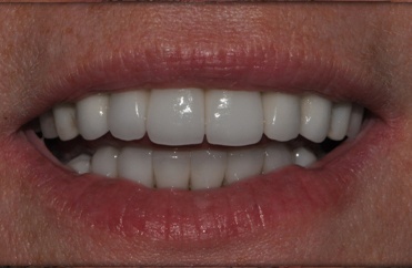 Smile after top teeth are replaced