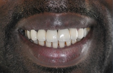 Smile after replacing top front tooth