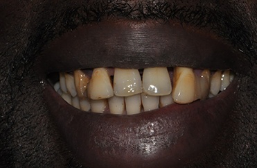 Smile with missing top front tooth
