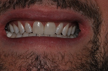 Smile after top teeth are replaced