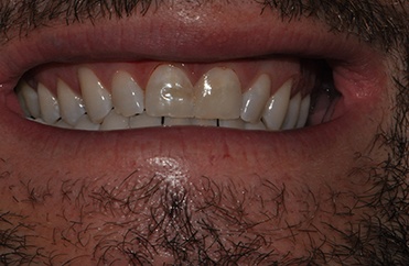 Smile with numerous missing top teeth