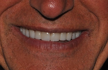 Smile after top teeth are replaced