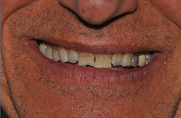 Smile with numerous missing top teeth