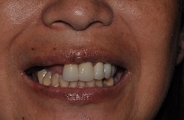 Smile after top teeth are replaced