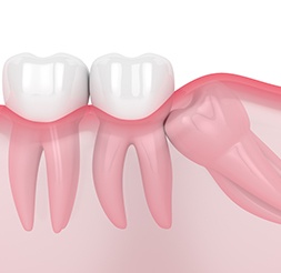 Animated smile with impacted wisdom tooth