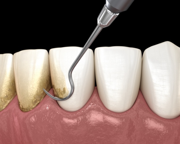 Animated smile during scaling and root planing treatment