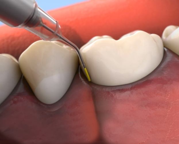 Animated smile during arestin antibiotic therapy