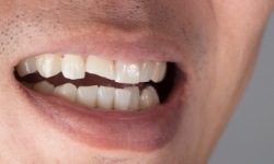 Closeup of smile with chipped front tooth