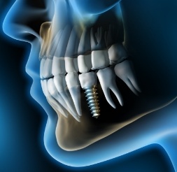 Animated smile with dental implant supported tooth replacement