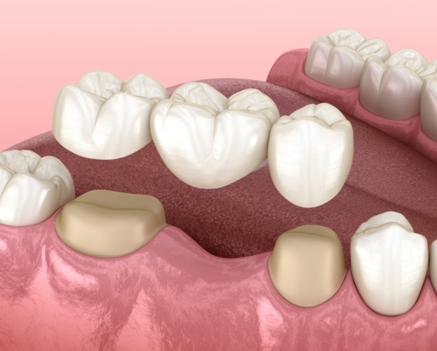 Animated smile during dental bridge placement