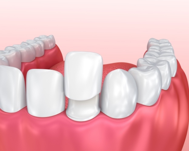 Animated smile during metal free dental crown placement