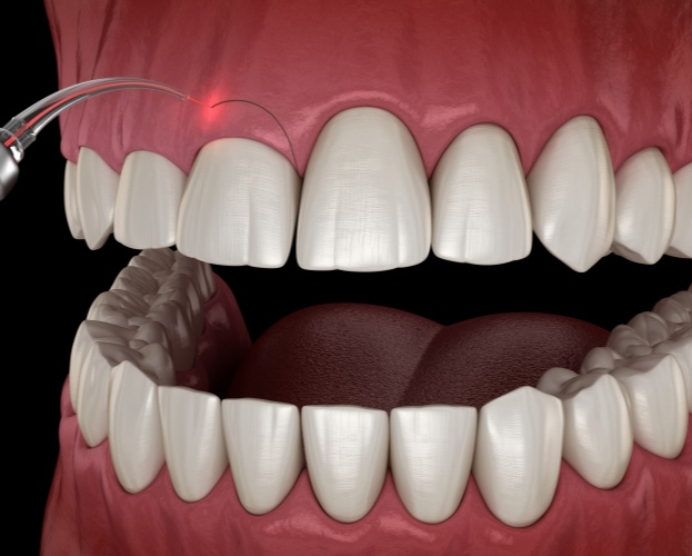 Animated smile during gum recontouring treatment