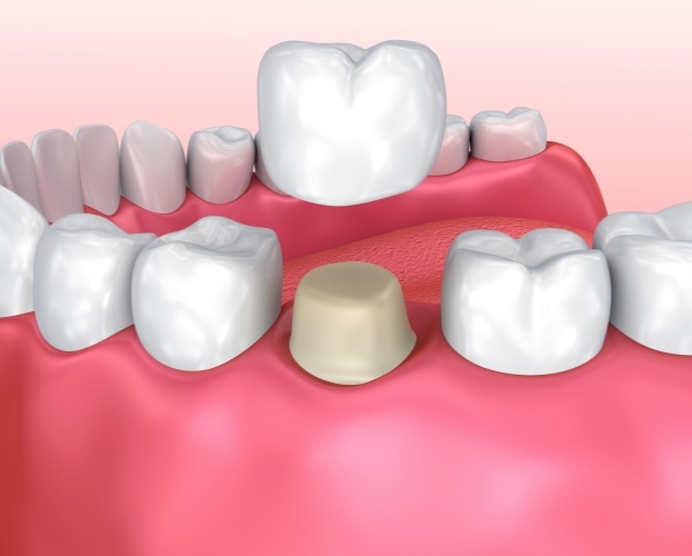 Animated smile during dental crown placement