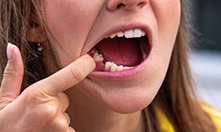 Woman missing a tooth