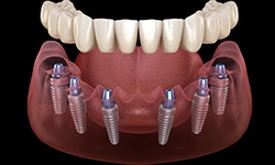 Illustration of implant dentures