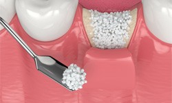 a digital illustration of bone grafting