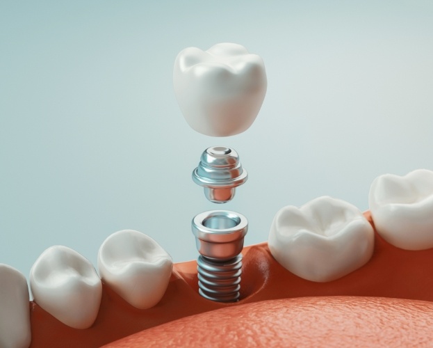 Animated dental implant supported replacement tooth placement