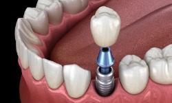 Animated dental implant supported dental crown placement