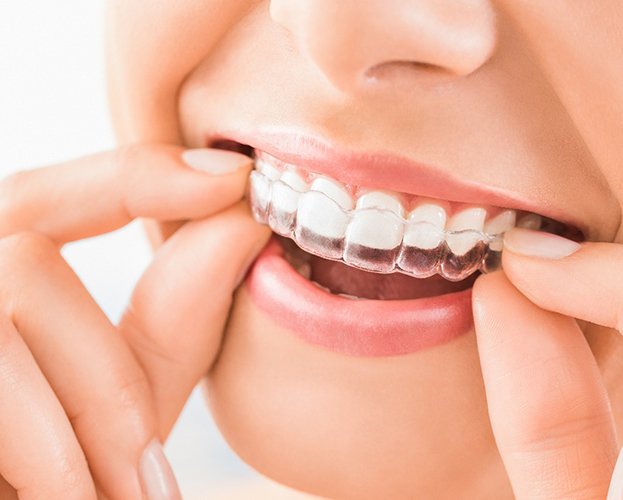 A woman putting on her Invisalign trays in North Providence