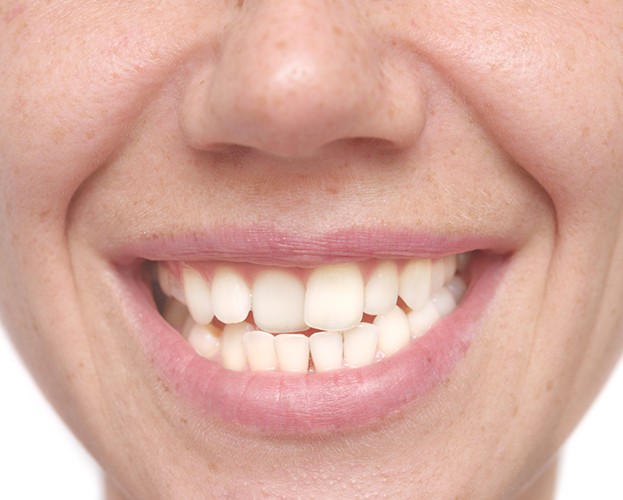 Teeth that need Invisalign from North Providence 