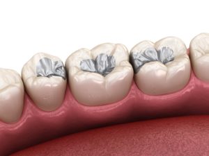 Illustration of three teeth in need of mercury-safe dentistry amalgam removal