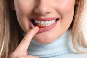 a woman showing her inflamed gums from periodontal disease