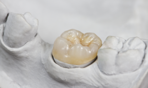 a closeup of a dental crown 